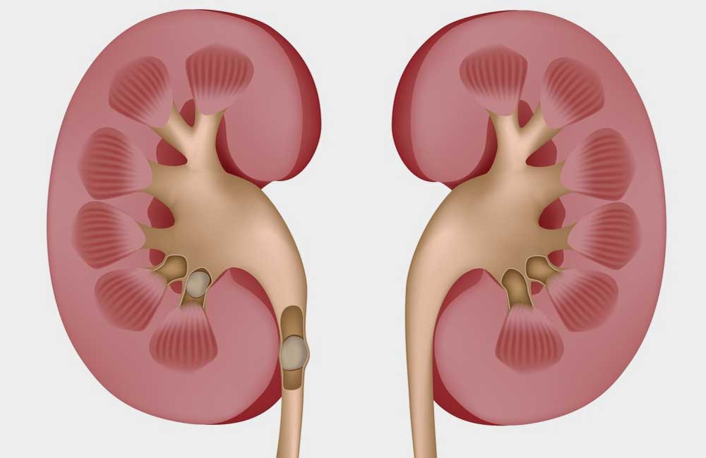 Kidney stones: symptoms, diagnosis and treatment